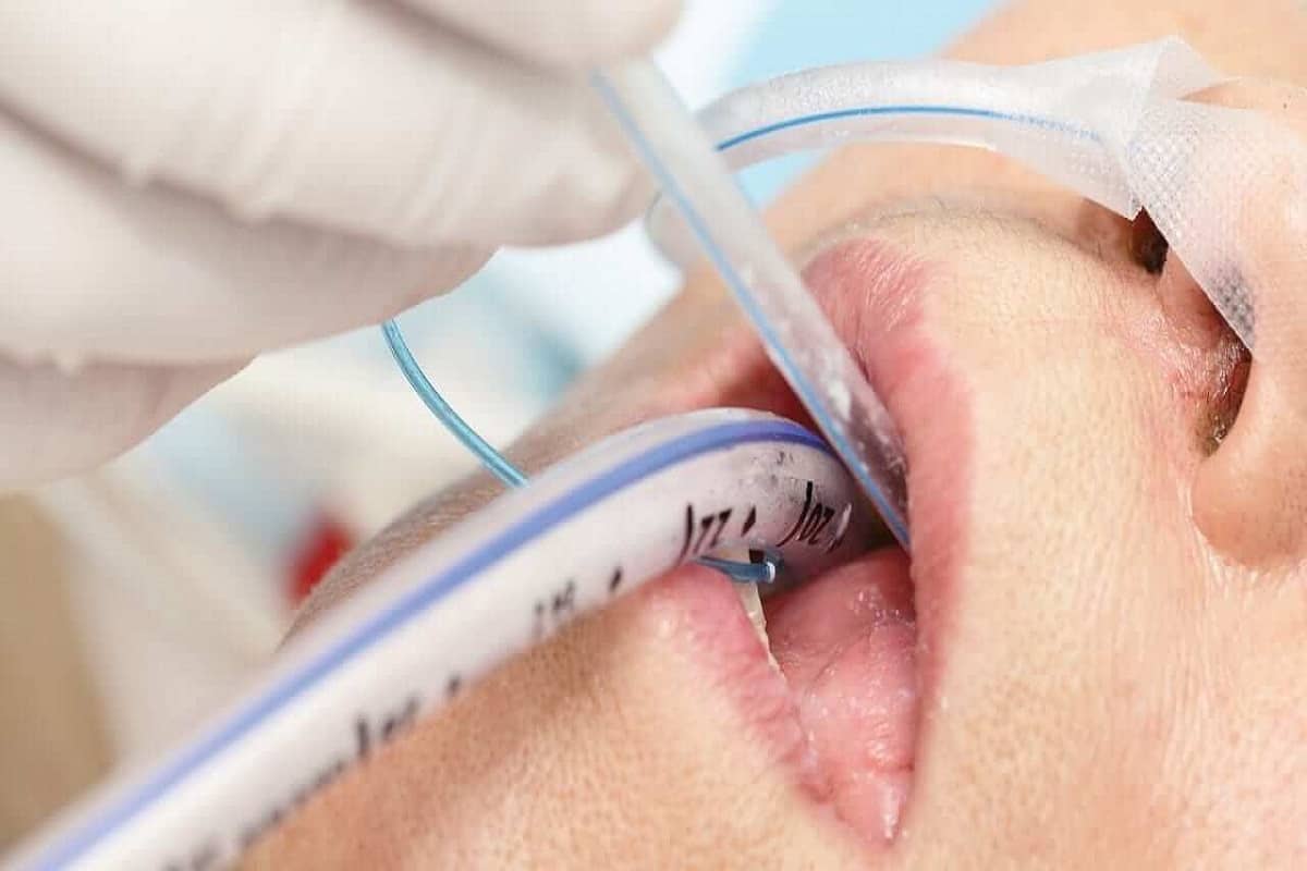 Oral suctioning of intubated patient with rigid catheter.