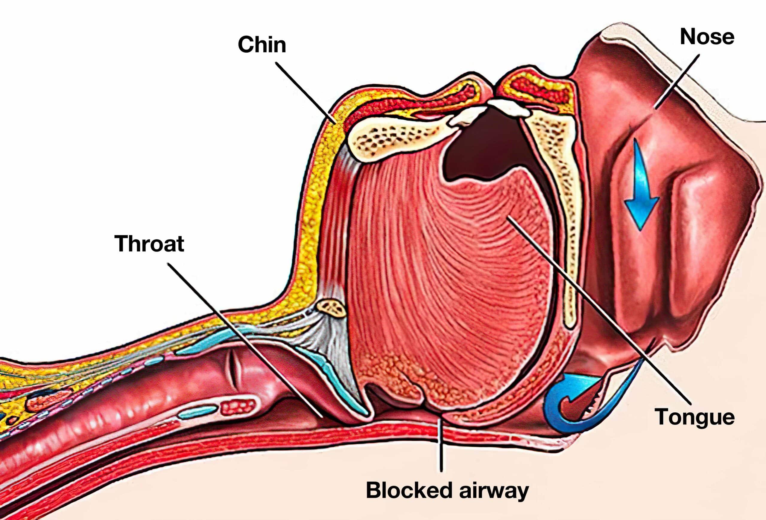 Tongue obstructing airway.