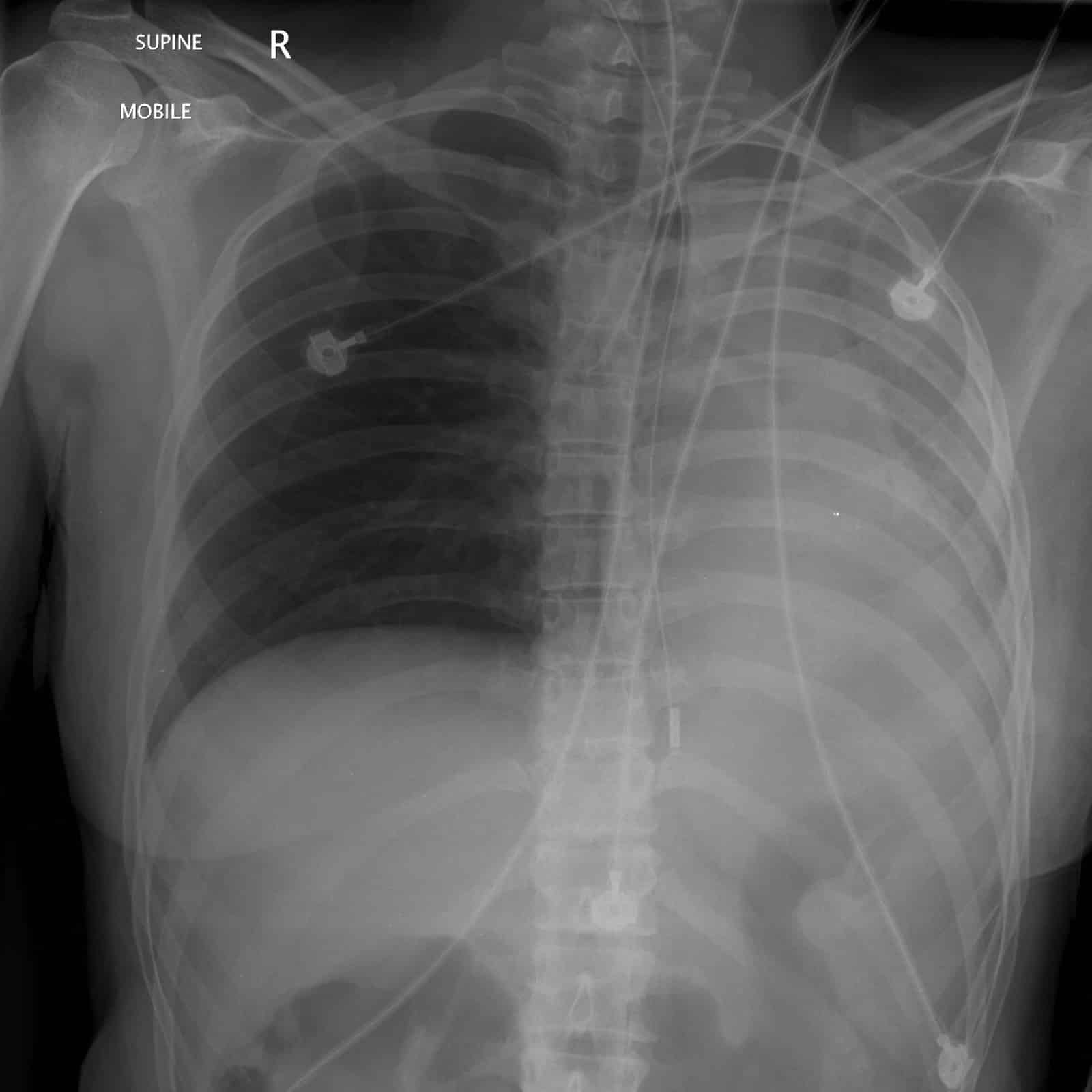 X-ray view right mainstem intubation with white markings indicating no air movement.