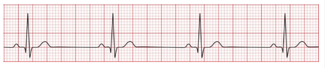  “ECG strip displays sinus bradycardia.”