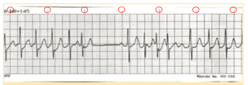 ECG strip with one-second markers.
