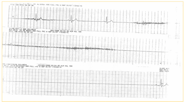 Prolonged sinus arrest ECG.