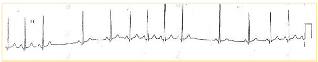 Second-degree type I sinoatrial nodal exit block.