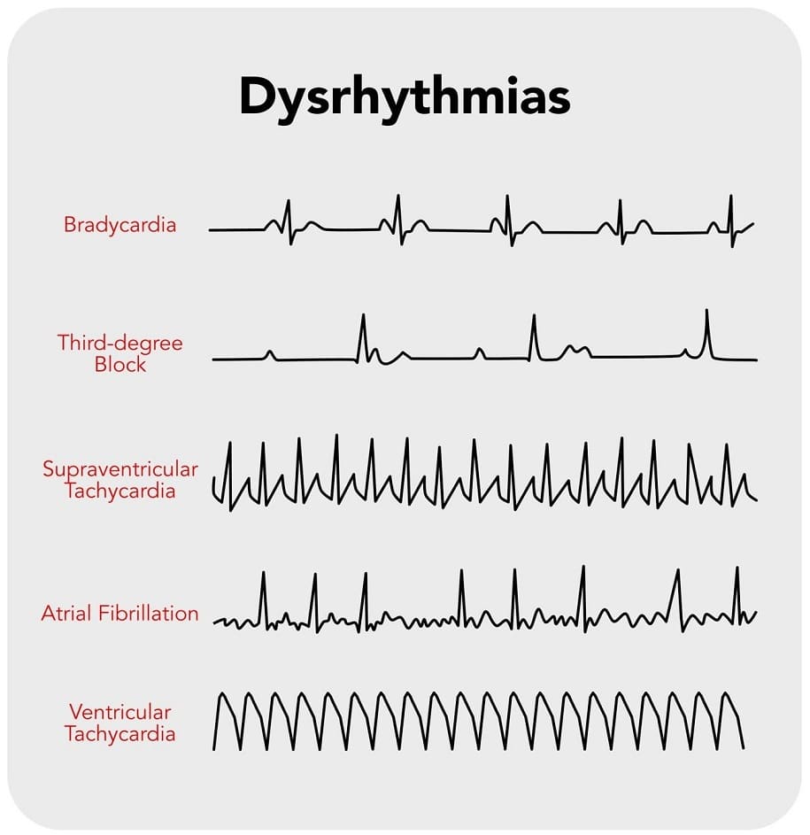 Five common types of dysrhythmias - ECG tracings.