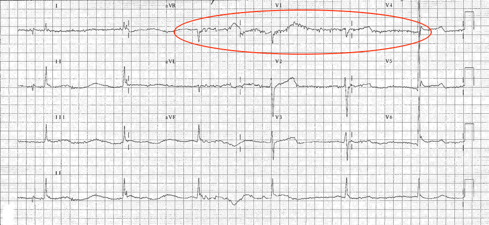 ECG of hypothermic patient.