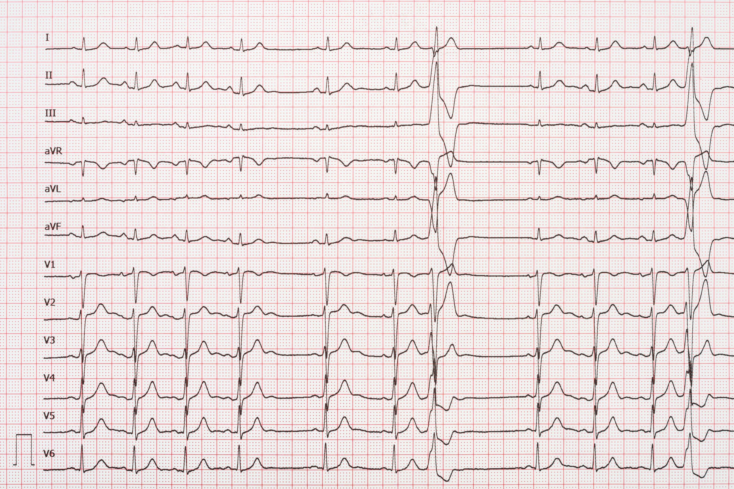 12-lead electrocardiogram tracing.
