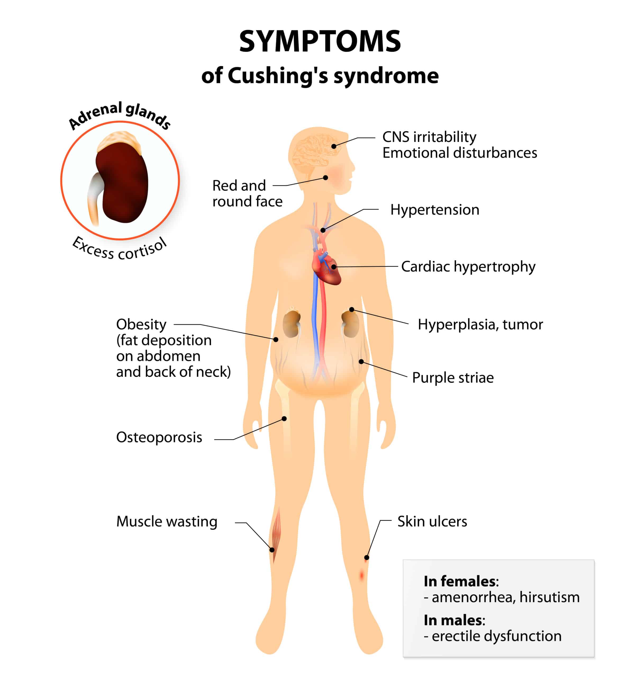 Diagram of symptoms of Cushing syndrome and disease.