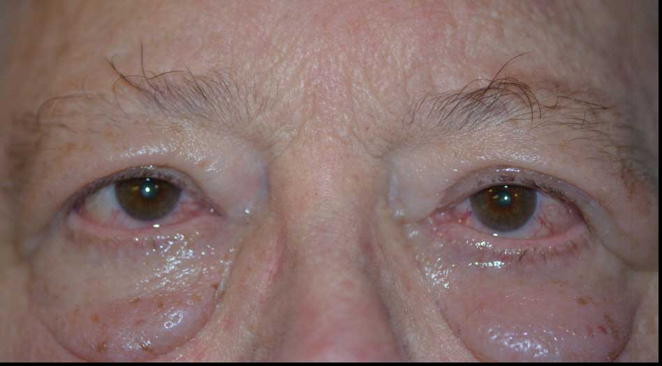 Hashimoto’s disease - manifests as puffiness under the eyes.
