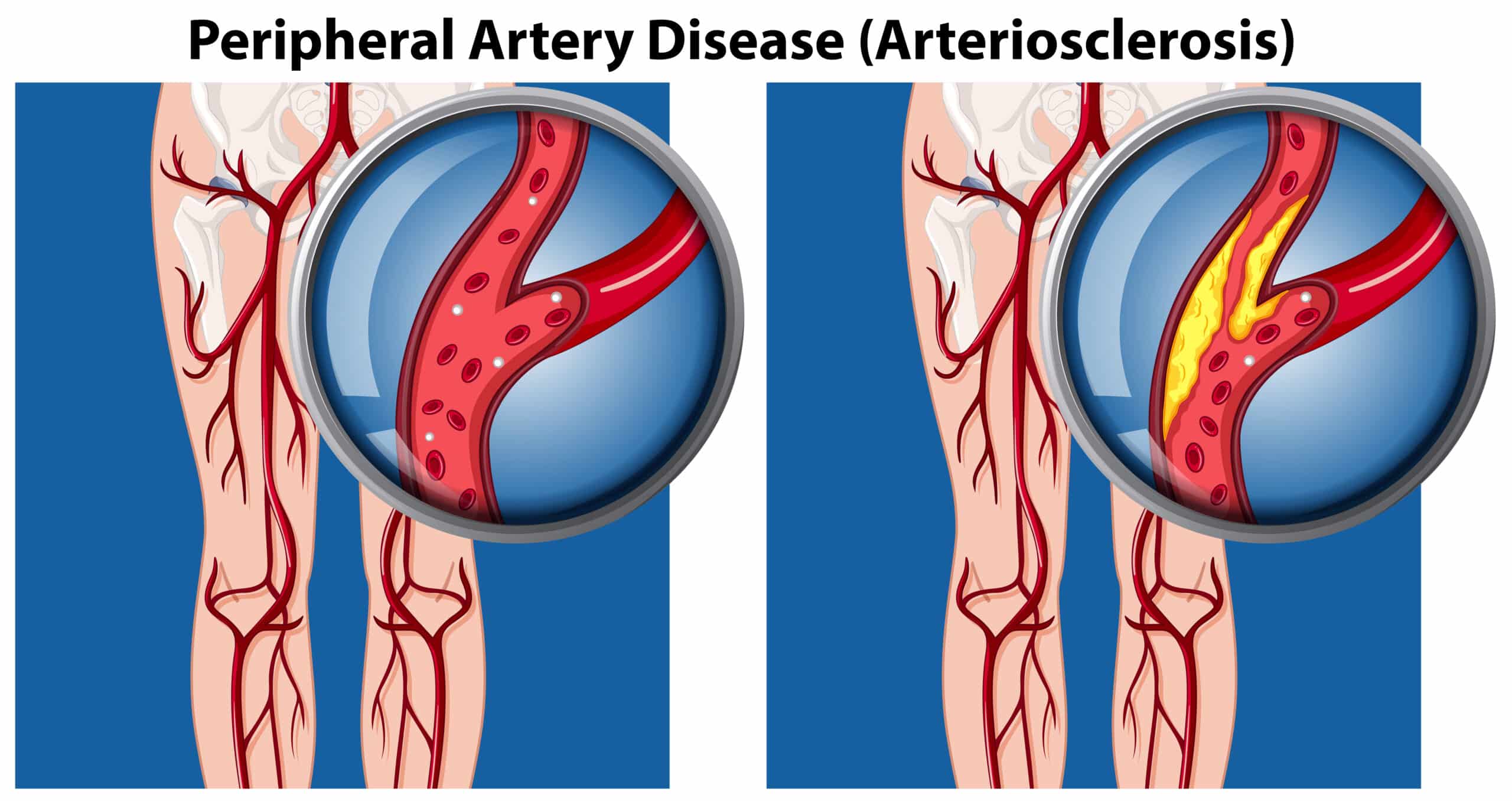 Peripheral Vascular Disease