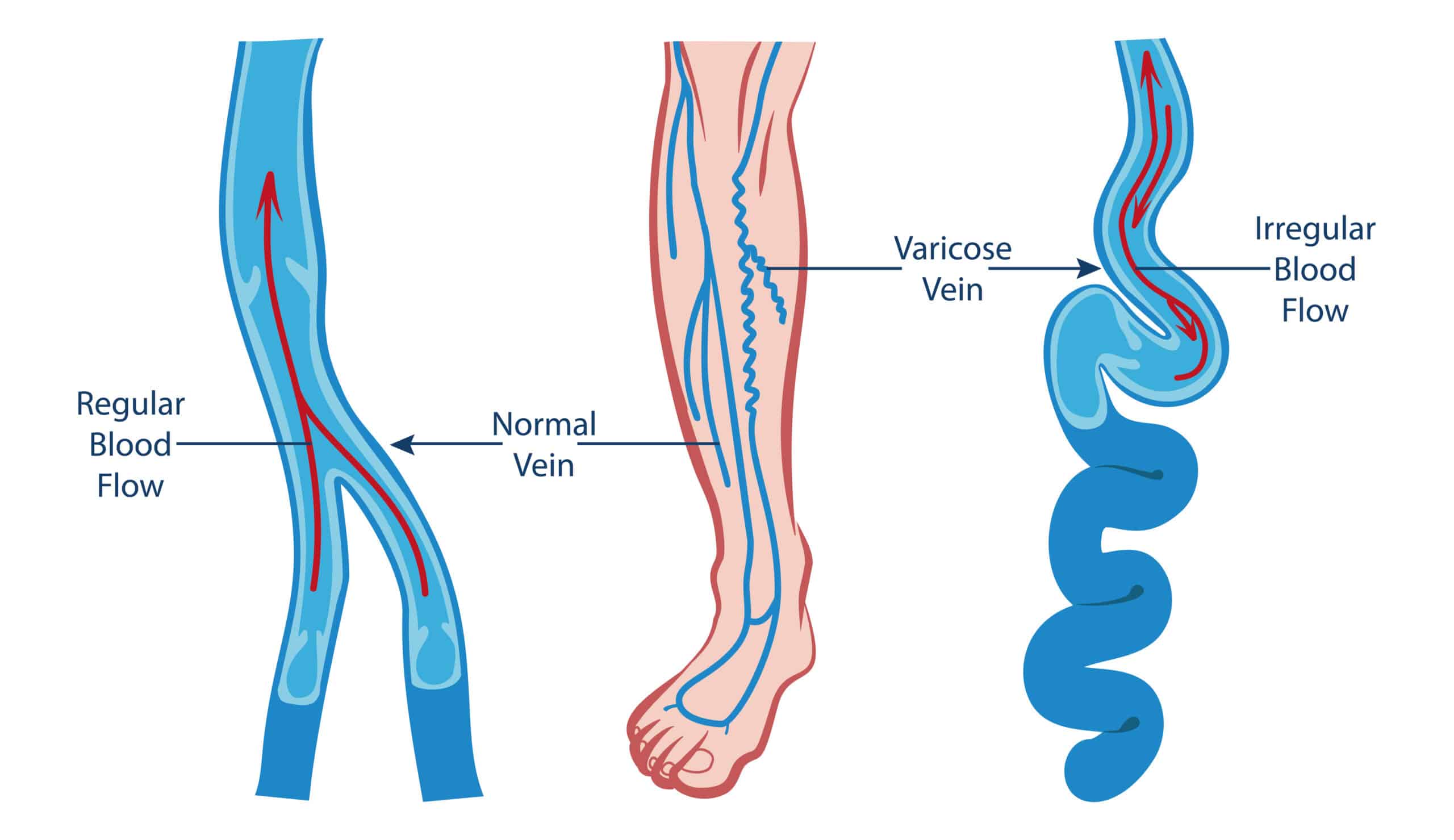 Sign of venous insufficiency - diagram of varicose veins.