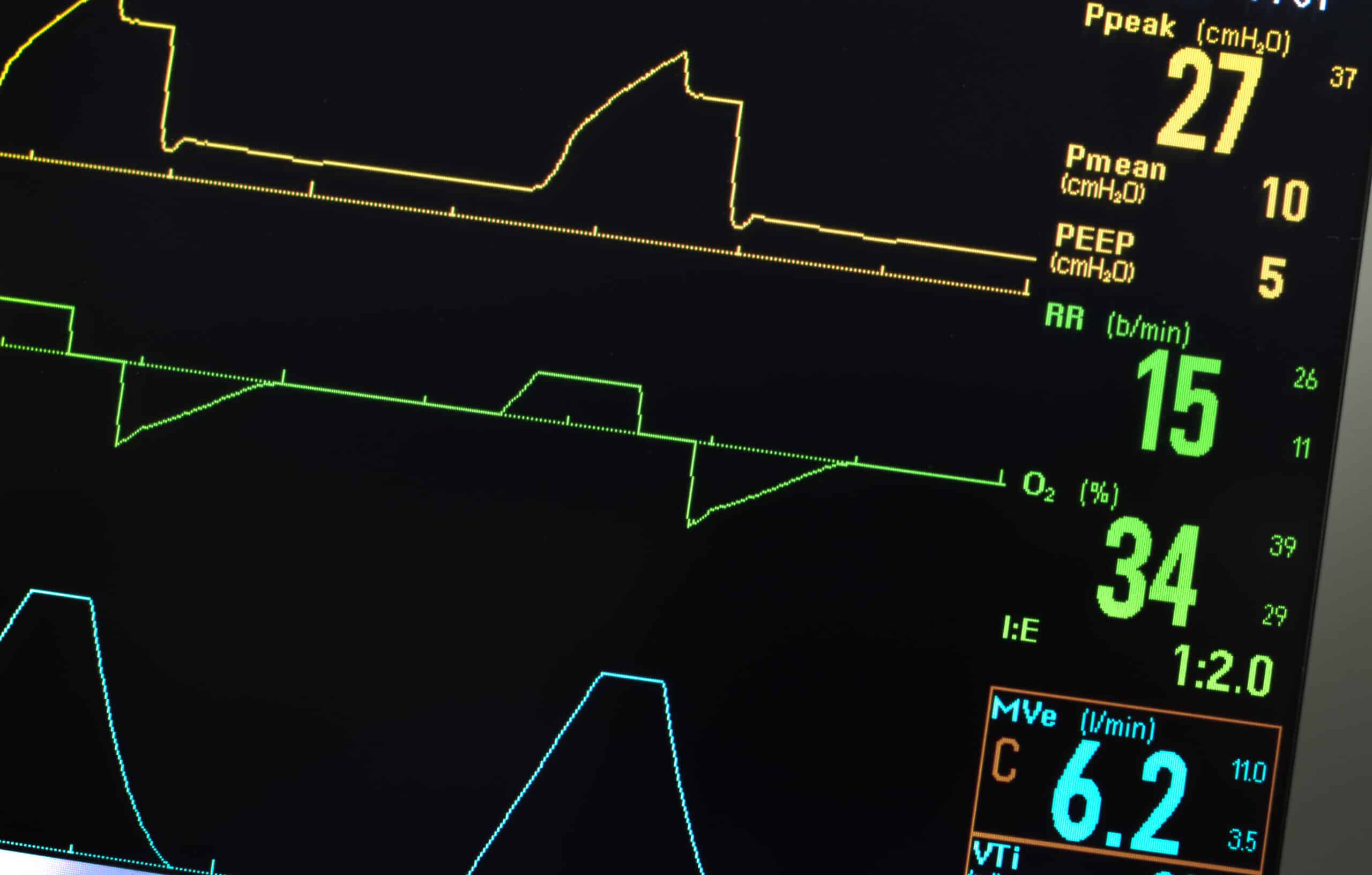 Ventilator monitor displays: PEEP, I:E ratio, and minute ventilation (MVe).