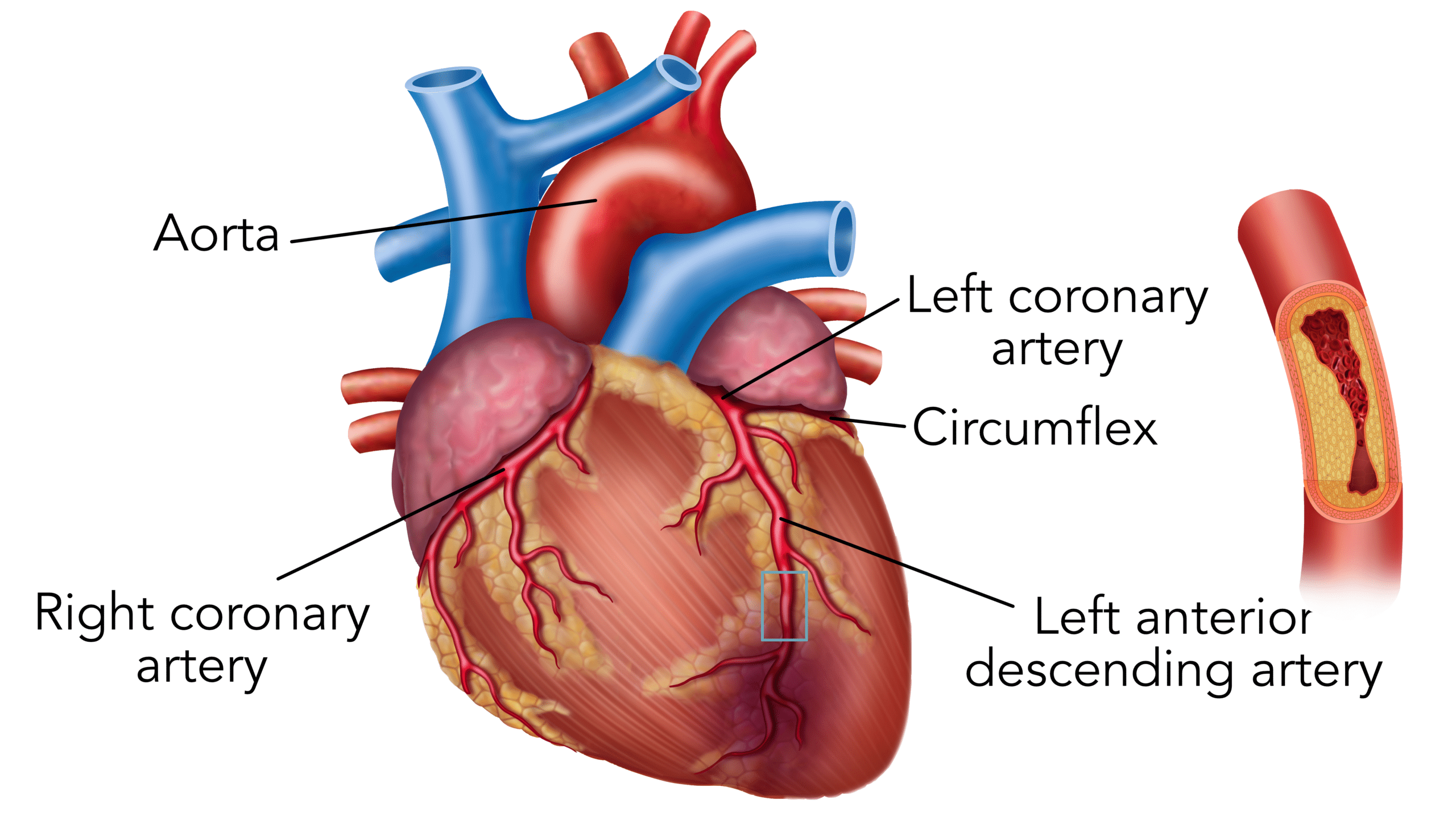 Blockage in the coronary arteries can cause myocardial infarction - diagram of a heart.