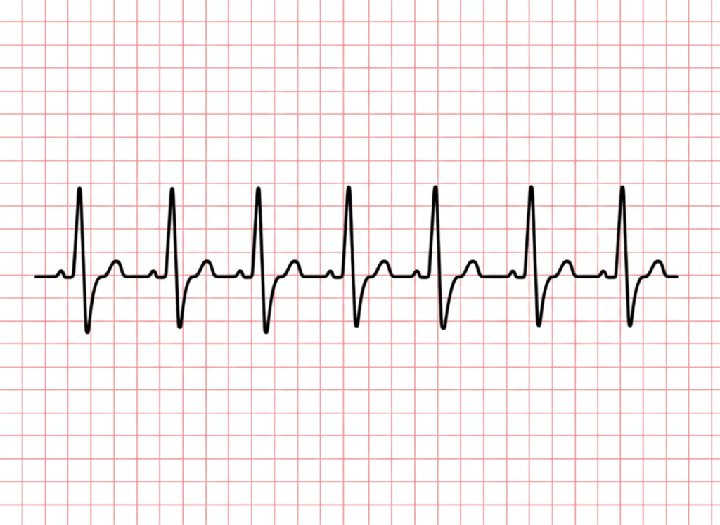 Abnormal notched P wave on ECG indicating atrial conduction abnormality