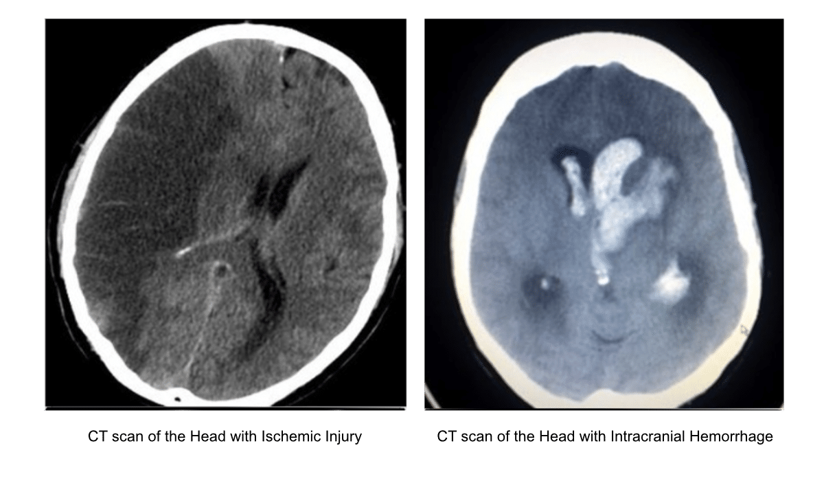 CT scan images - ischemic and hemorrhagic stroke.