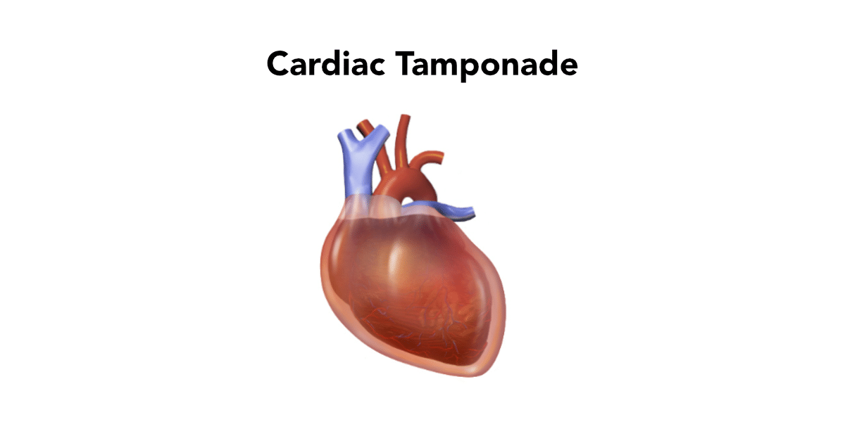 Image of heart - Cardiac tamponade is the accumulation of fluid within the pericardium.