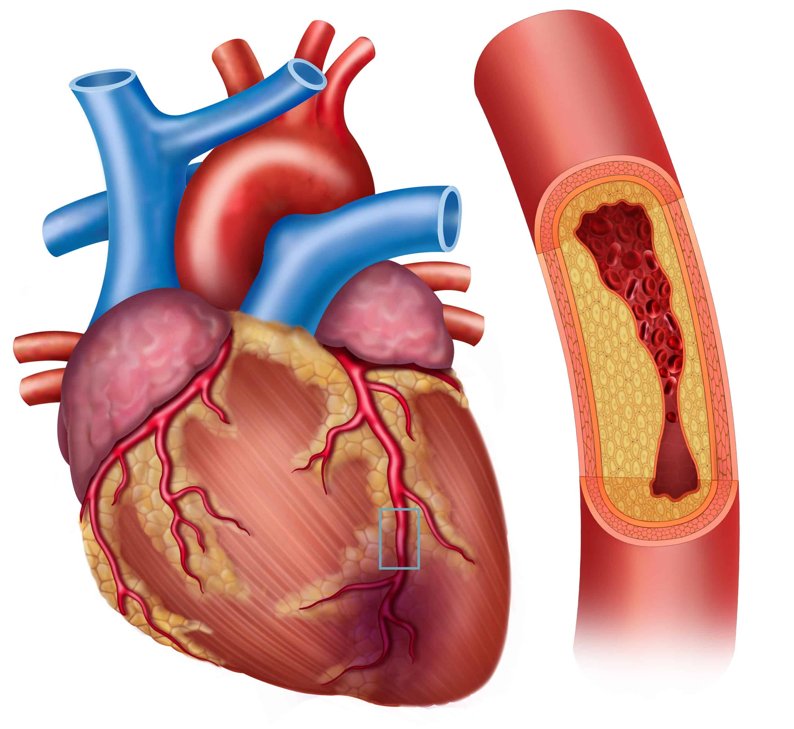 Coronary artery disease - image of the heart and clogged coronary arteries.