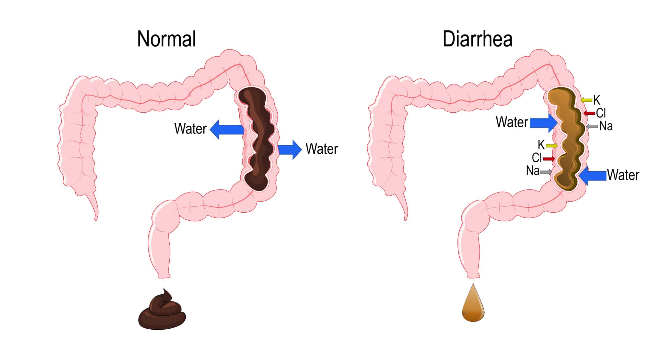 Fluid loss from diarrhea is a common cause of hypovolemia - diagram of the lower GI tract.