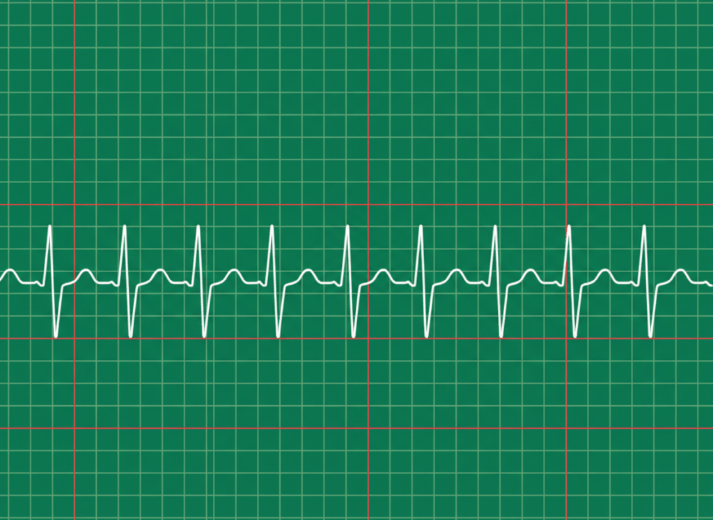 Normal P wave on ECG showing smooth rounded atrial depolarization before each QRS complex