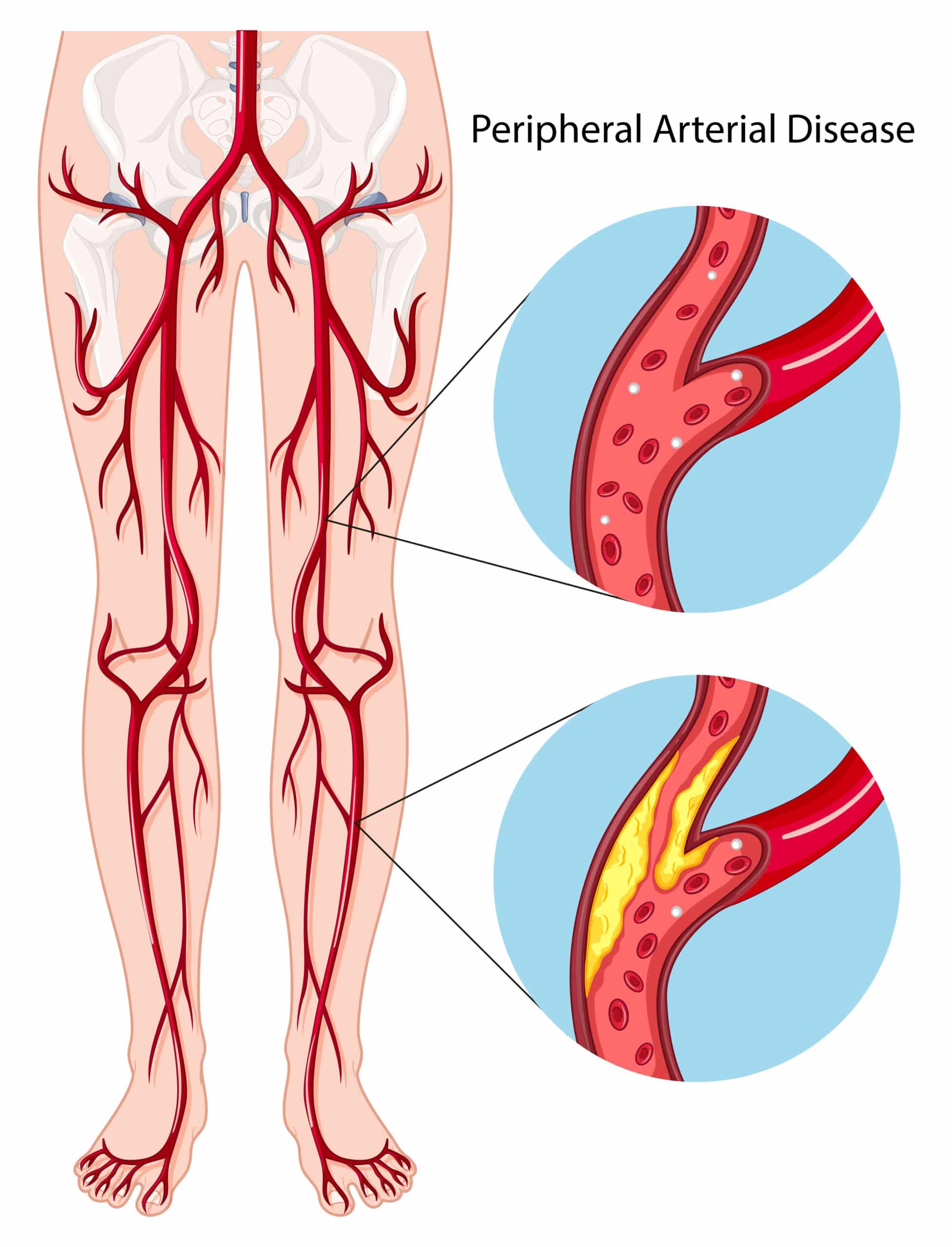 Peripheral arterial disease diagram.