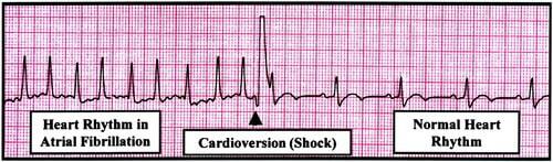Example of cardioversion on an ECG tracing.
