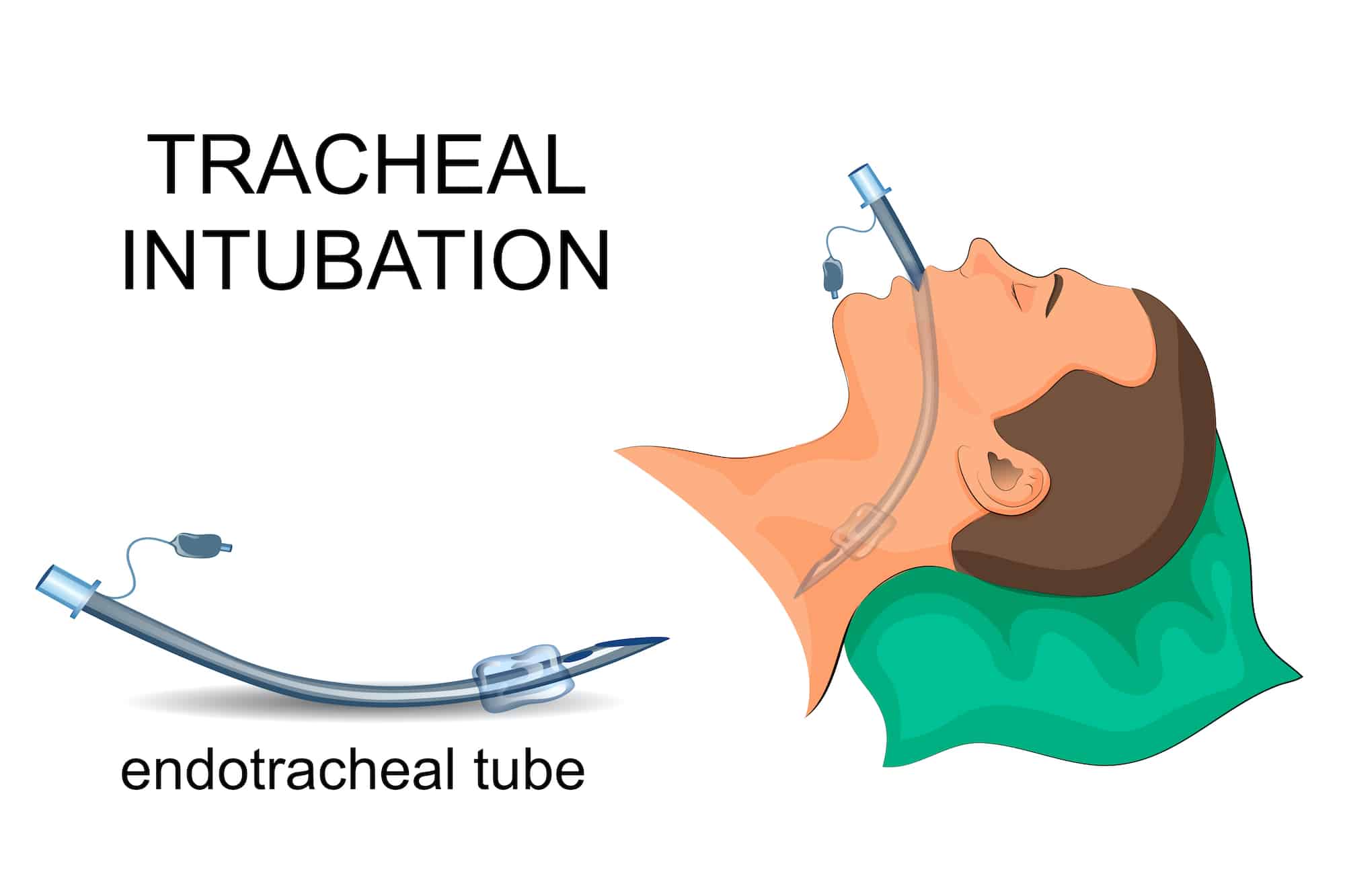 Man with tracheal intubation.