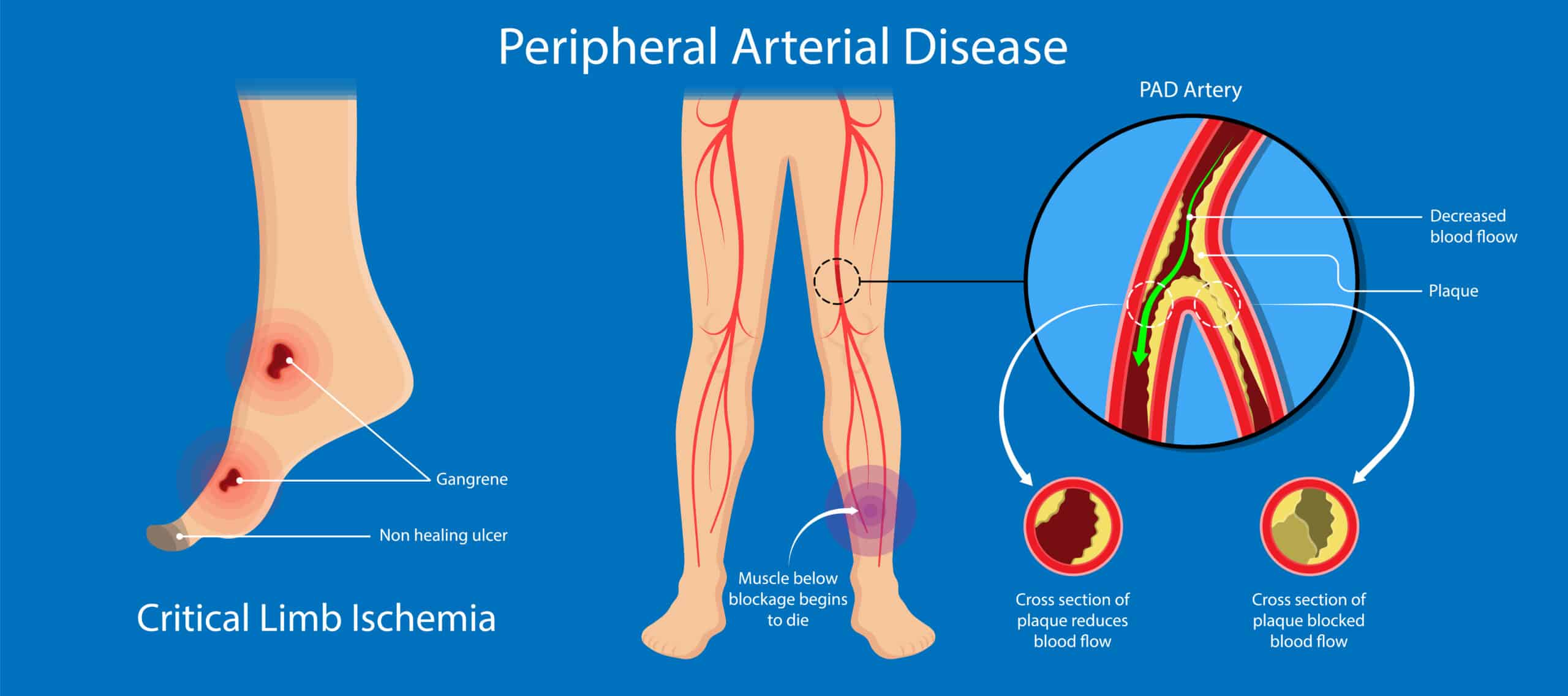 Ulcers are common on the outside of the foot in peripheral arterial disease - diagram of foot, legs, and arteries.