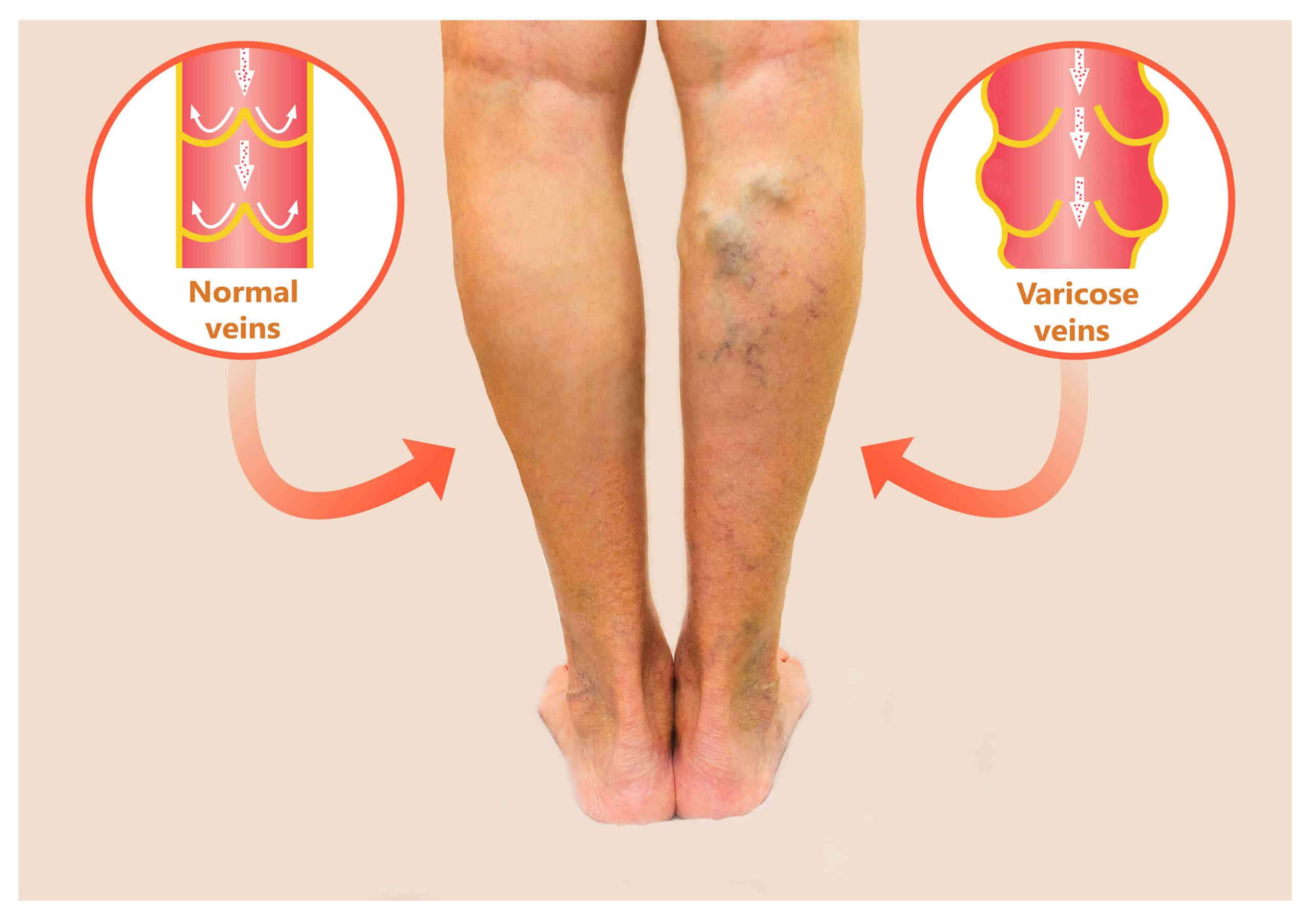Varicose veins - legs with bulging veins.