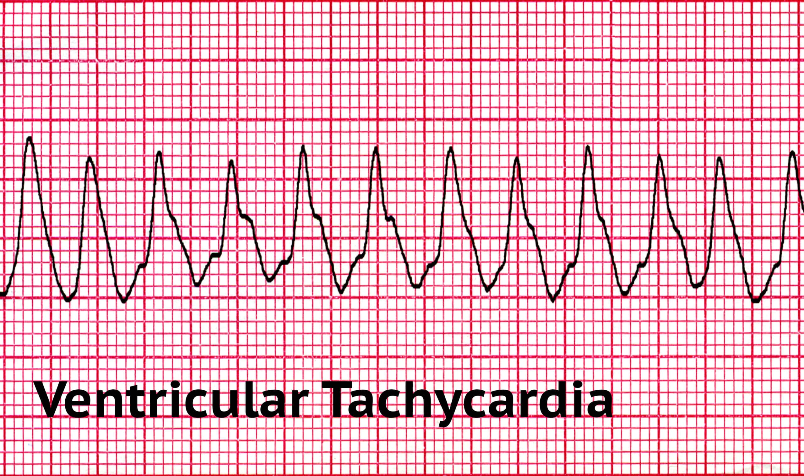 Ventricular tachycardias shown on an ECG tracing.