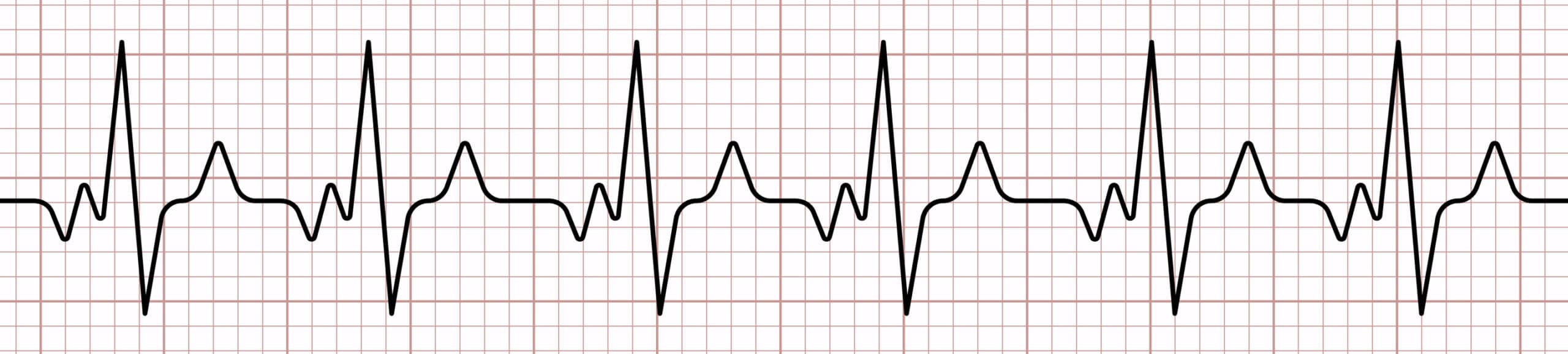 12-lead ECG evaluates heart’s electrical activity.