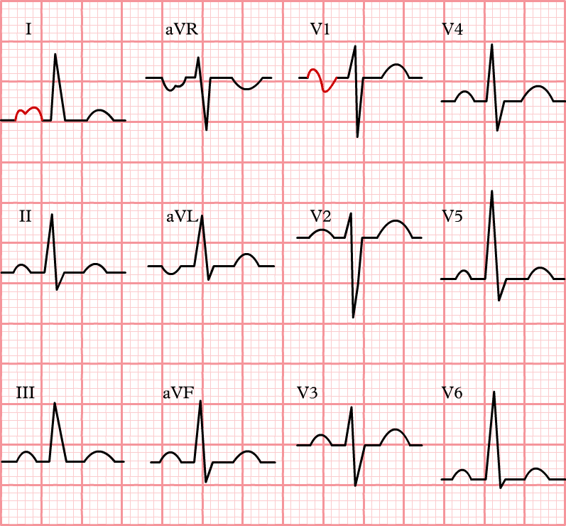 12-lead ECG P mitrale with inverted T wave.