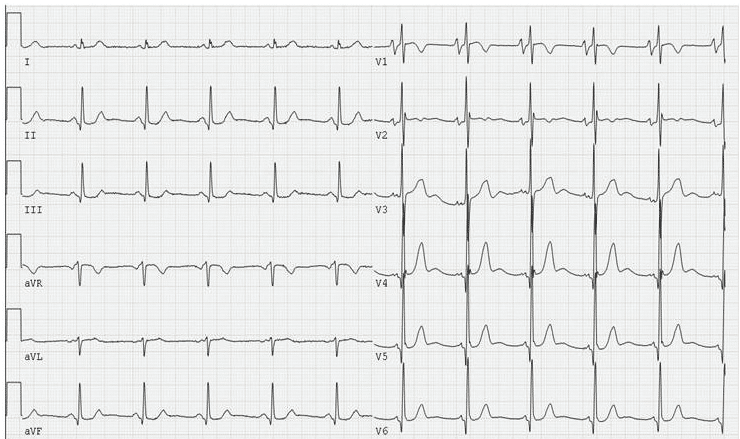 12-lead ECG P mitrale with PQ interval of 0.16 seconds.