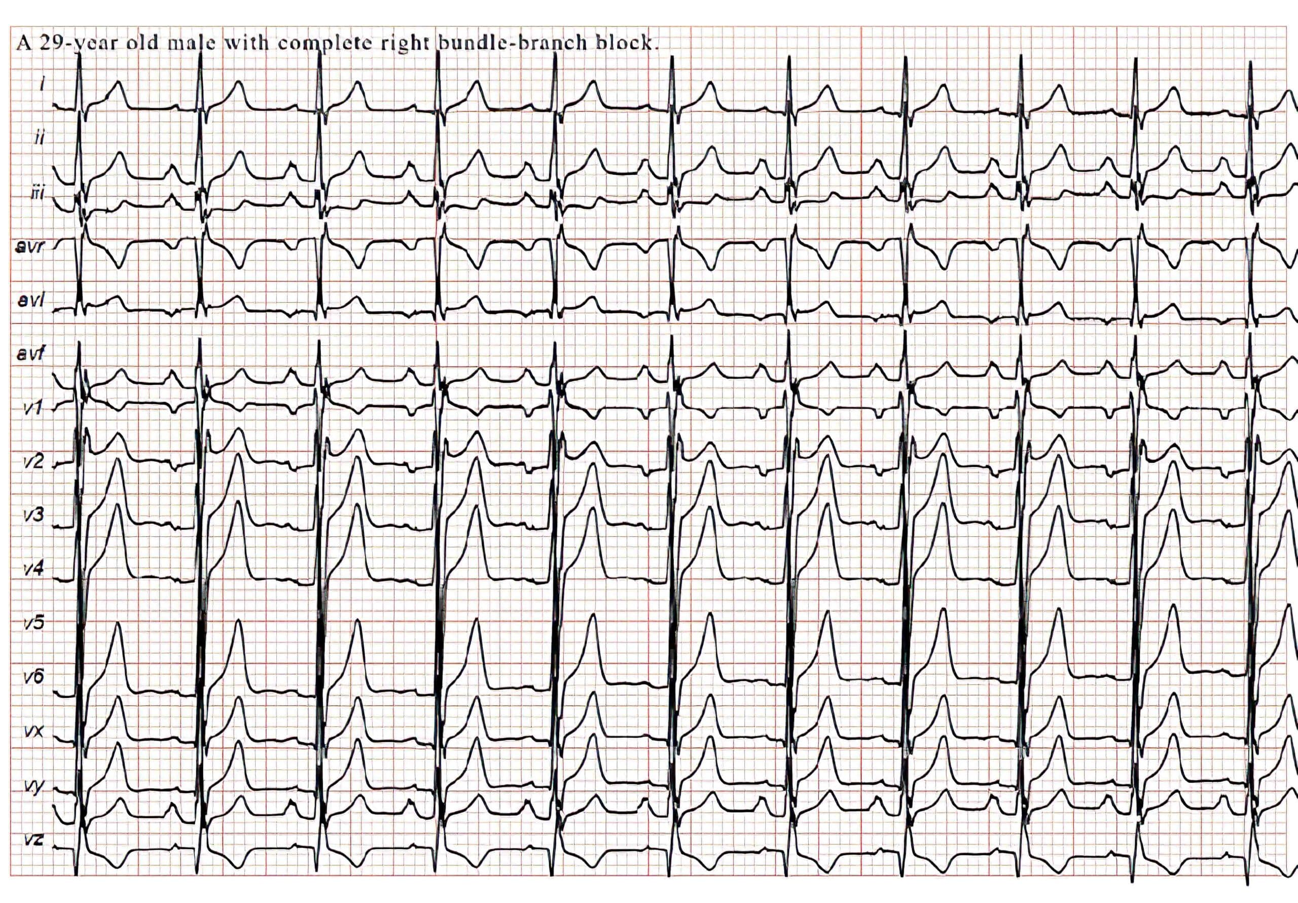 29-year-old man with complete RBBB ECG.