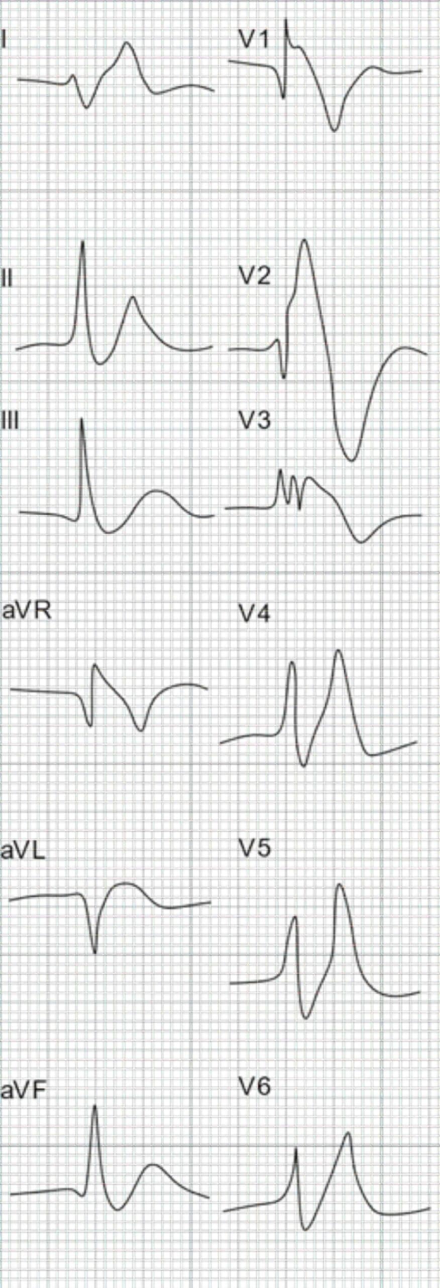 “48-year-old man with renal failure and hyperkalemia ECG.