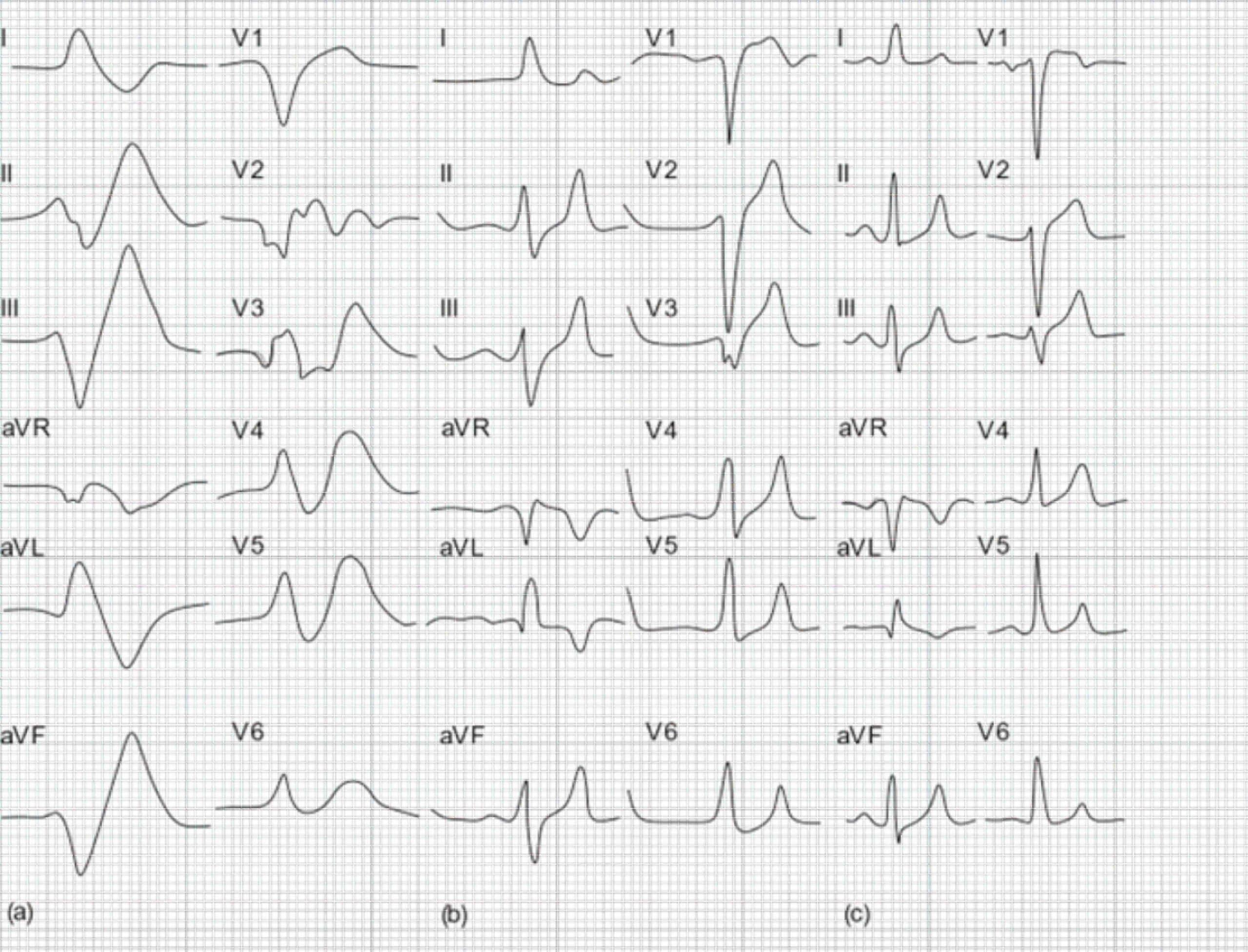 72-year-old man with chronic renal failure ECG.