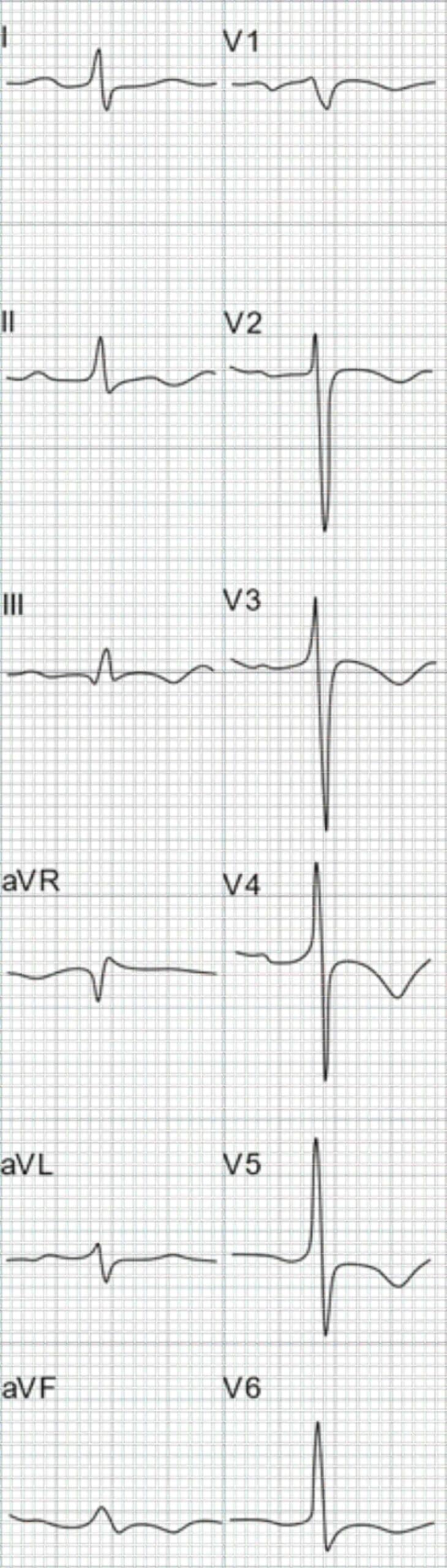 76-year-old man with CAD and COPD ECG.