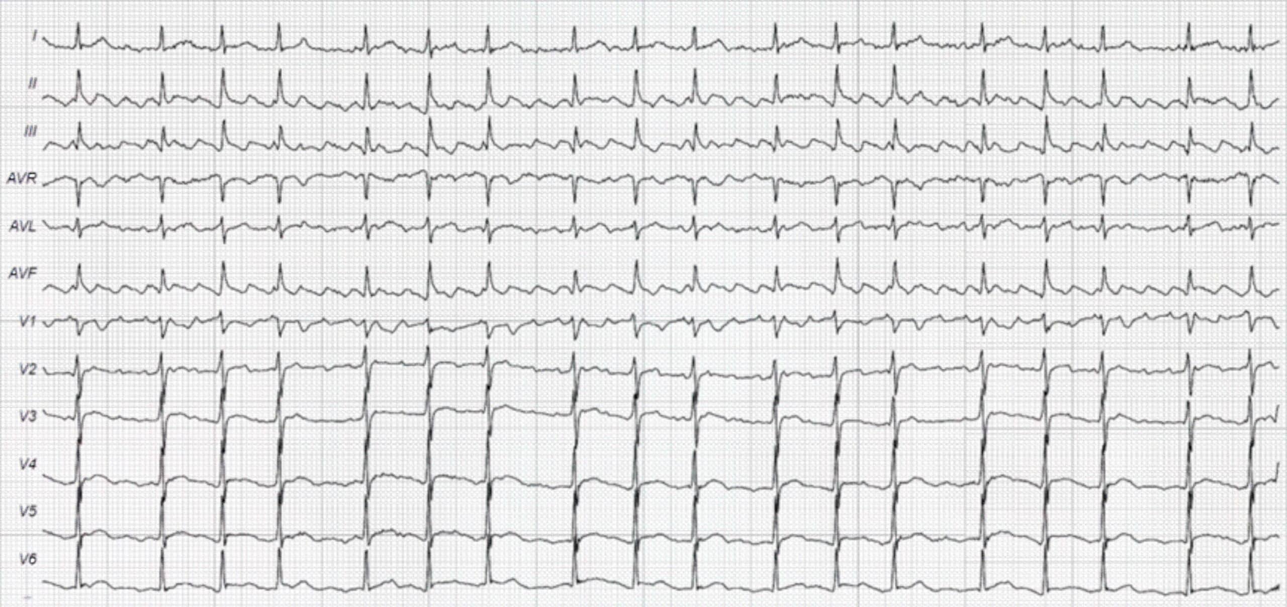 77-year-old man with history of palpitations but otherwise asymptomatic ECG.