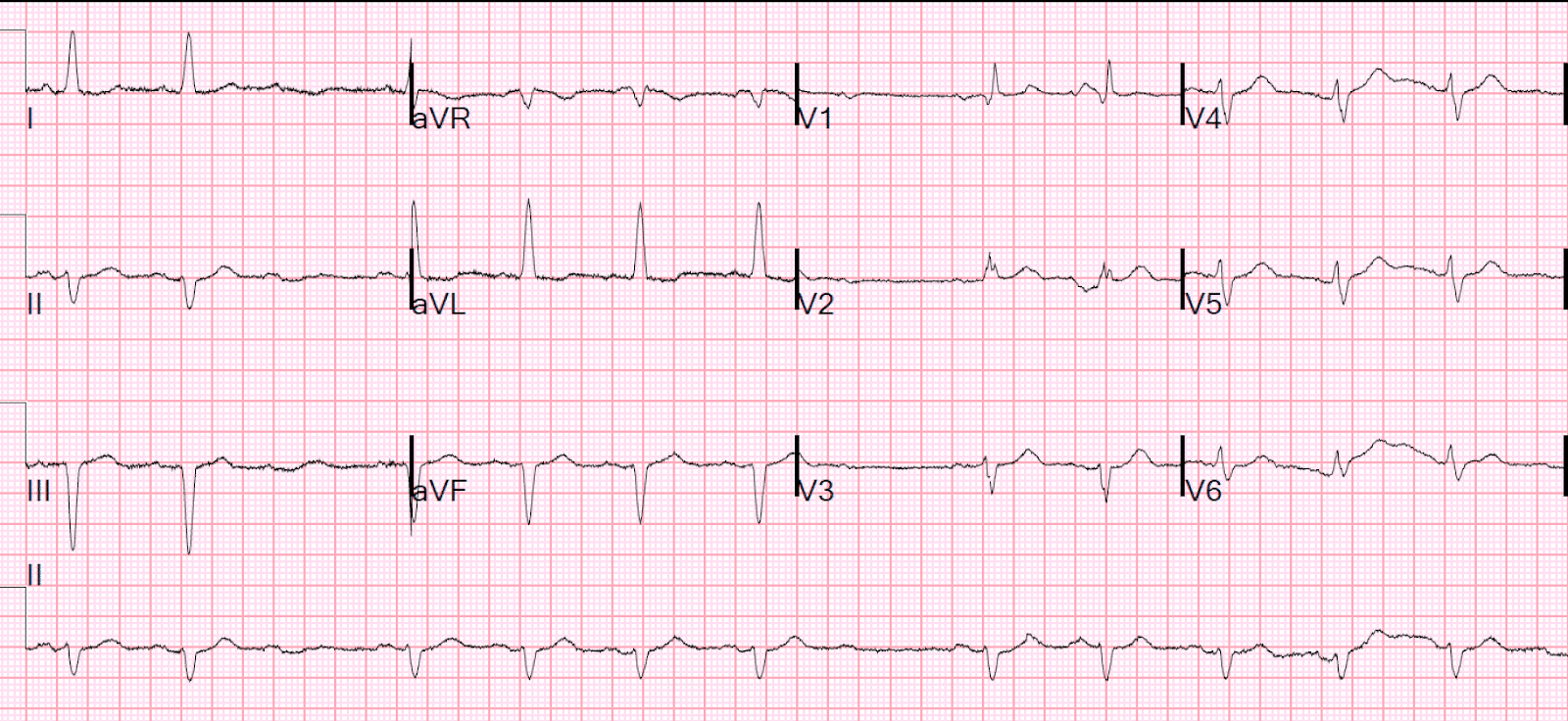 80-year-old man hip fracture ECG.