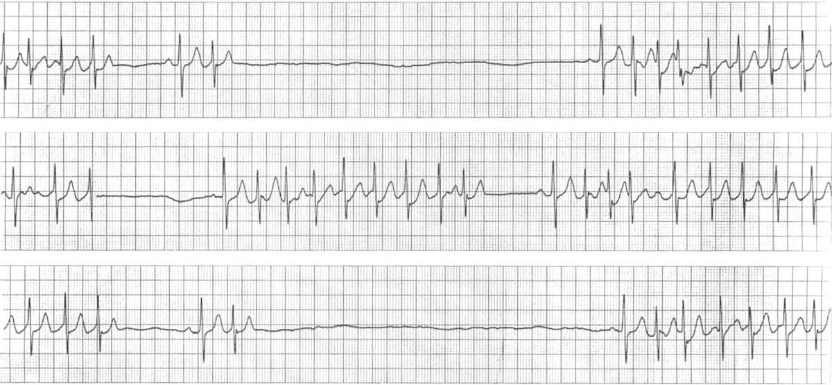 Bradycardia-tachycardia syndrome ECG.