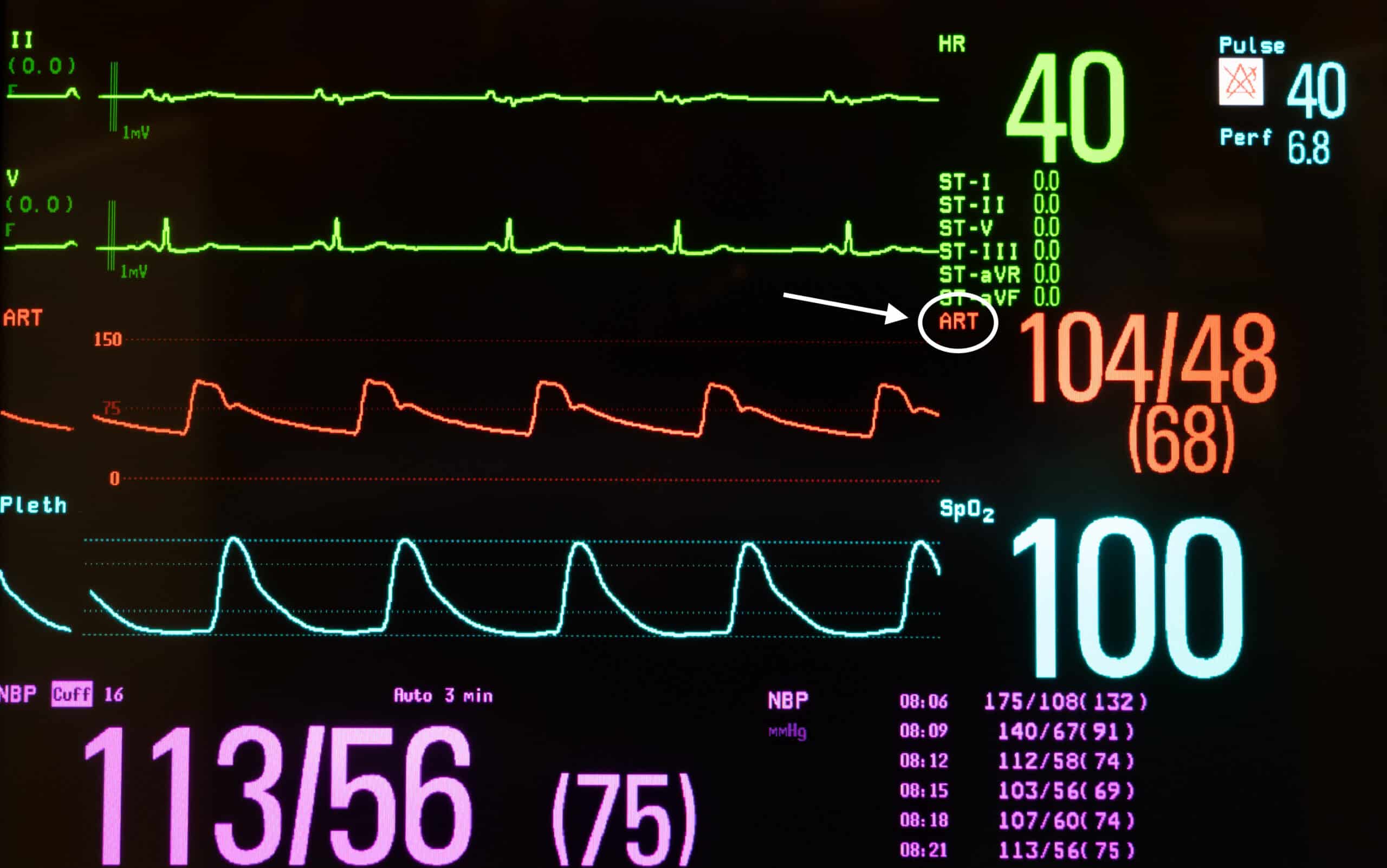 Cardiac monitor arterial waveform.