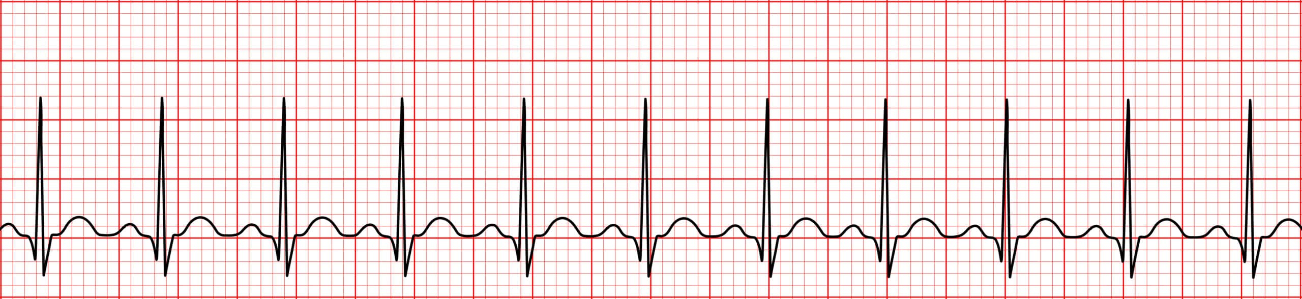ECG reading sinus tachycardia.