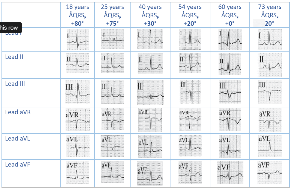 The normal cardiac rhythm is produced by impulses that originate from the sinus node. Figure 2 represents the frontal plane axis and showcases the P vector and the P wave morphology in the different limb leads.