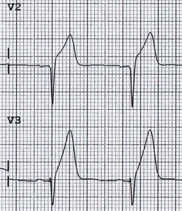 Hyperacute T waves present in patient with Prinzmetal or vasospastic angina.