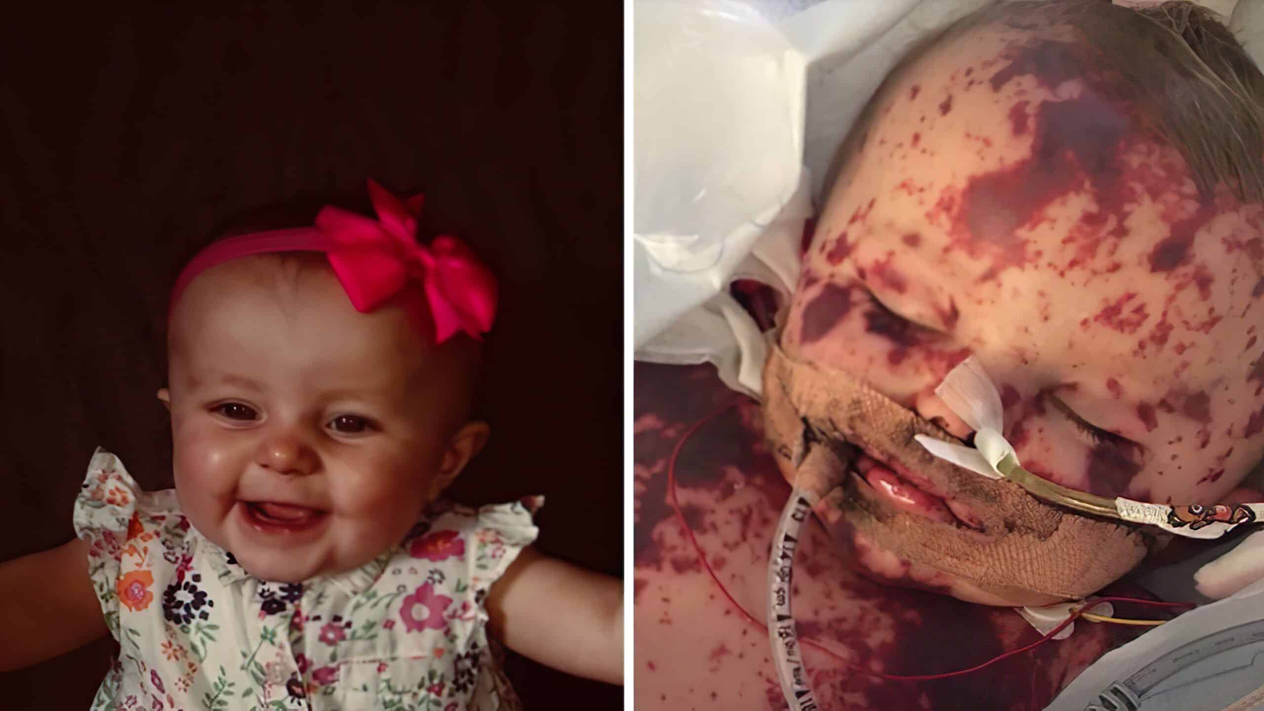 Infant with severe meningitis.