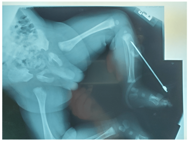 Manual IO insertion from 25 years ago.