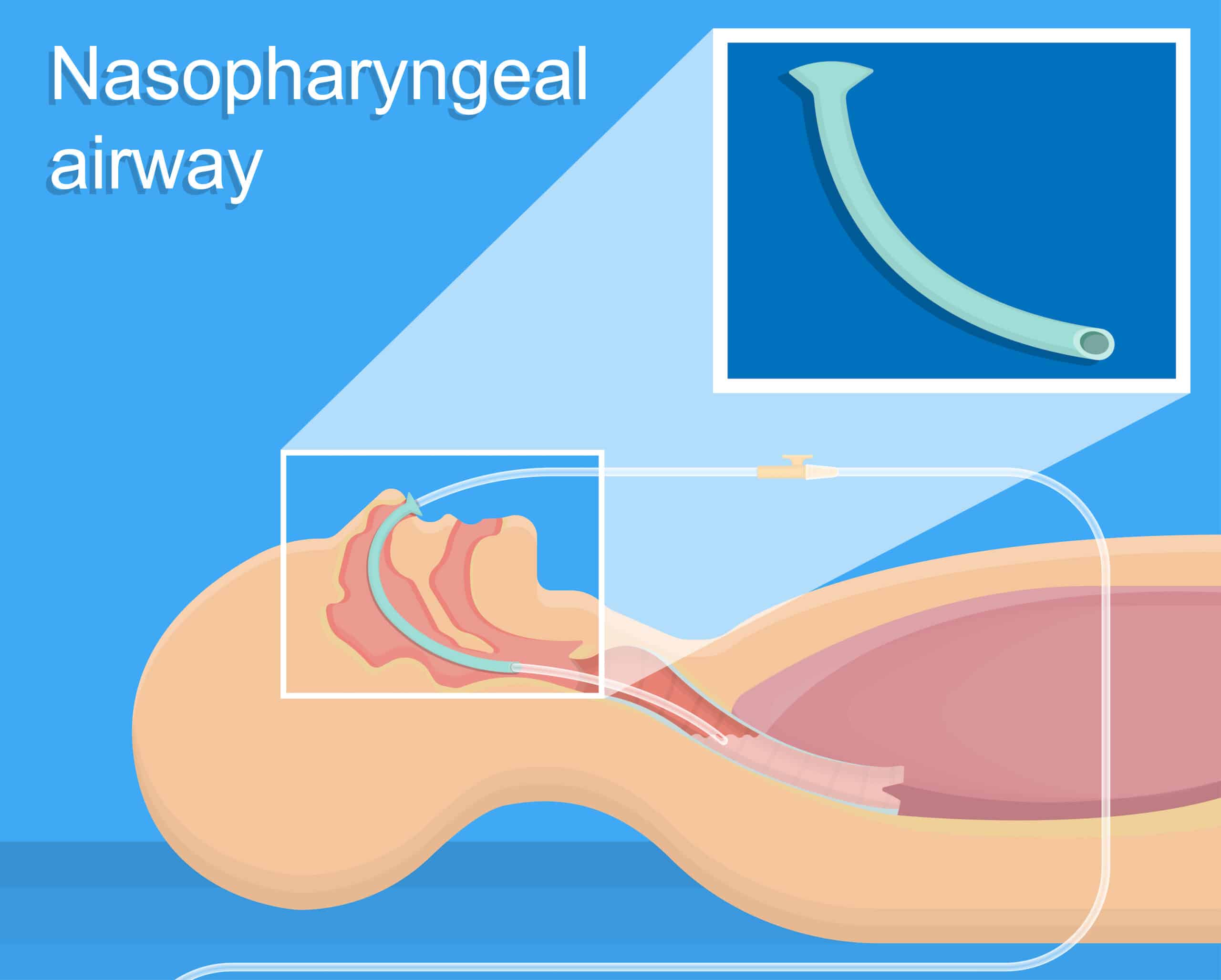 Nasopharyngeal airway insertion.