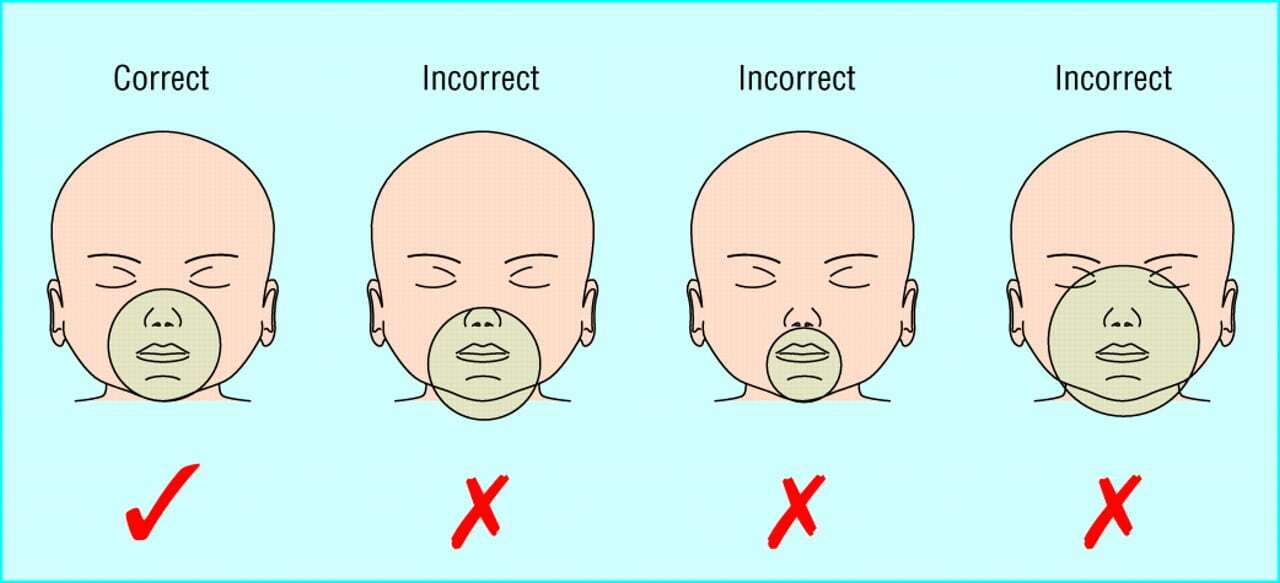 Proper size of pediatric bag mask.