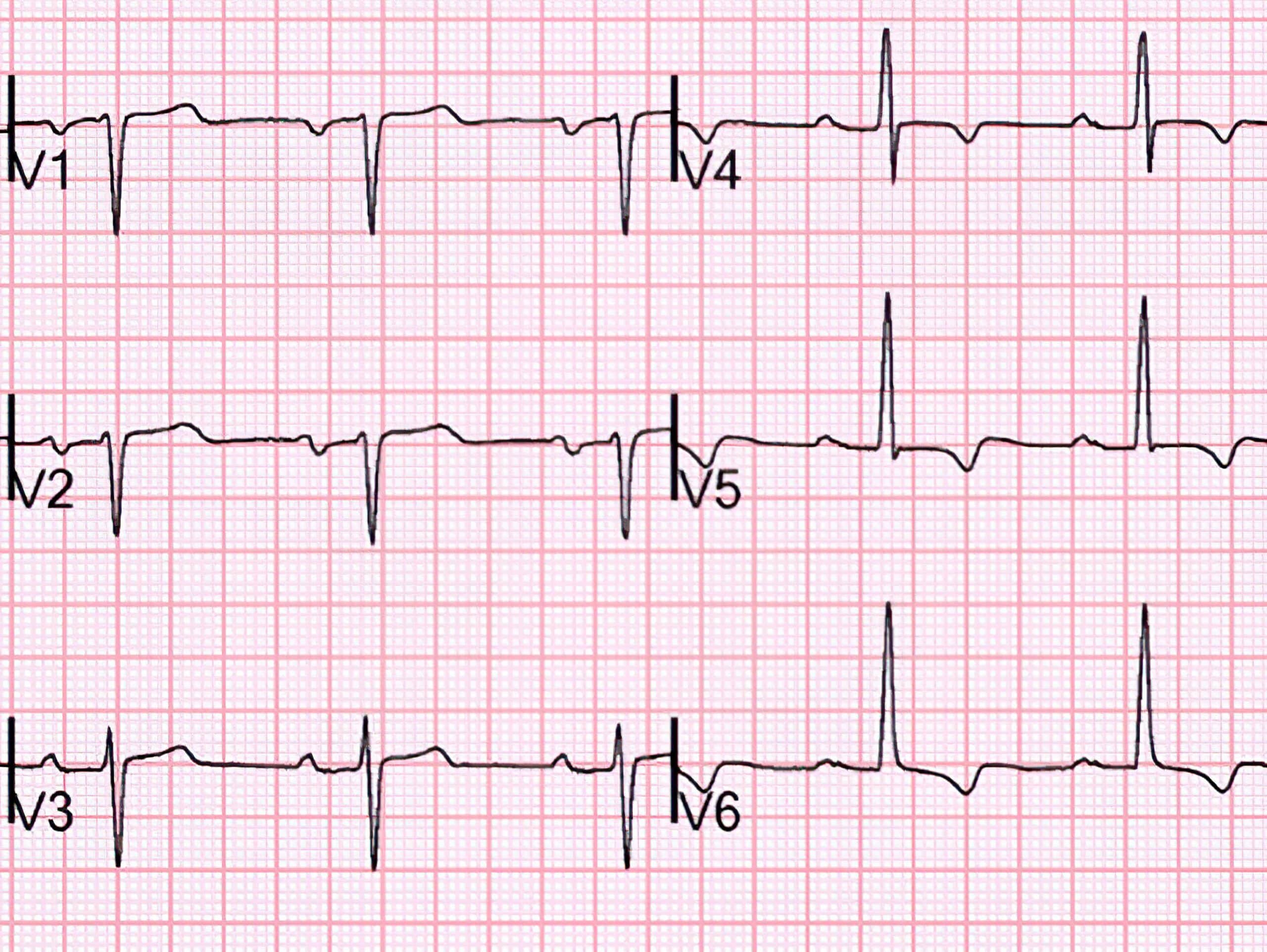 QRS complex transitioning from negative to positive deflection.