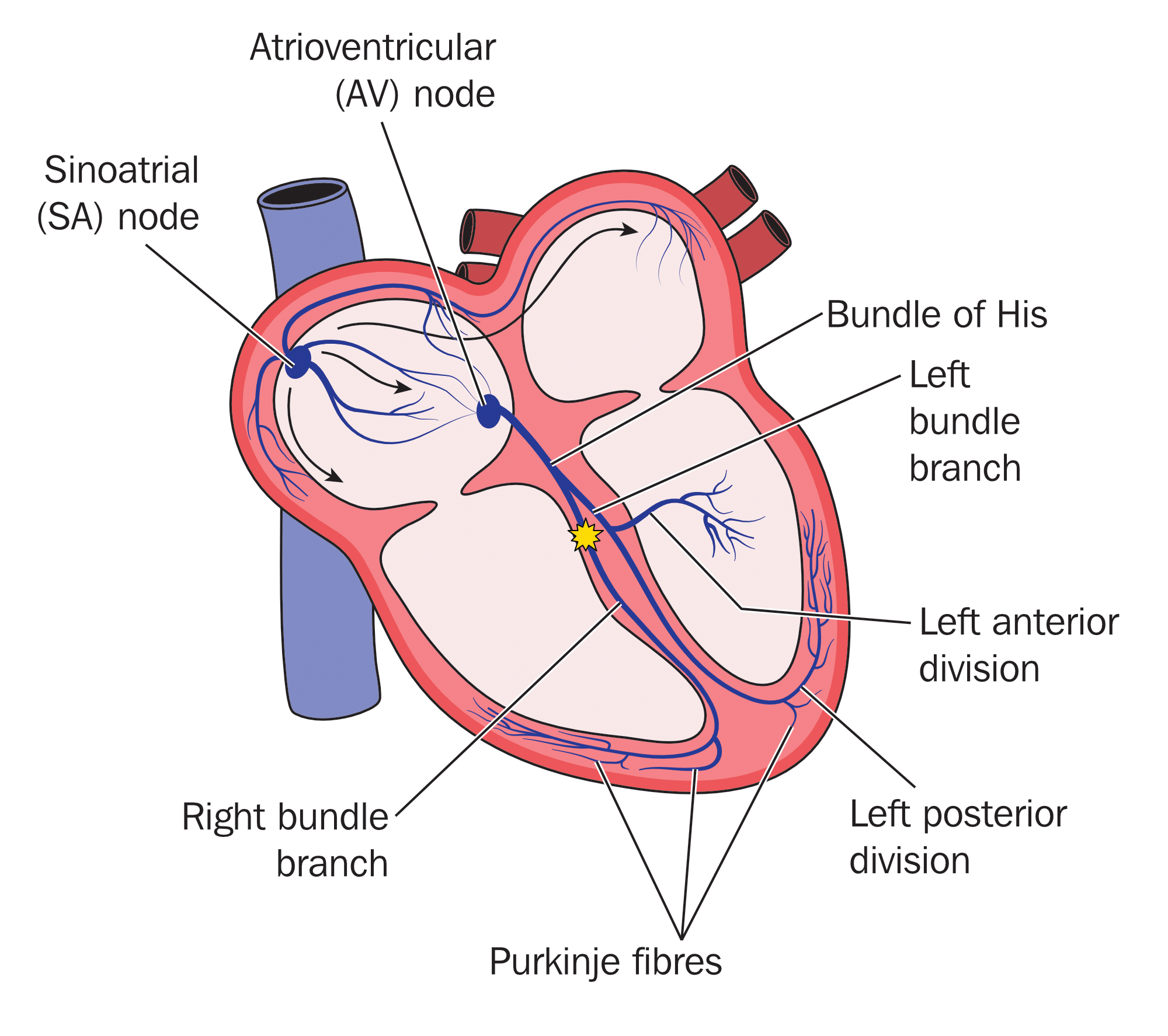 Right bundle branch block illustration.