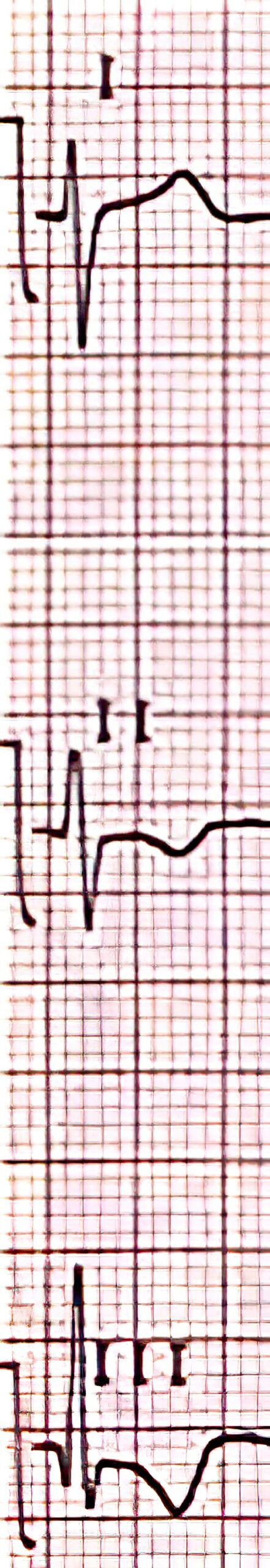 SI/SII/SIII pattern with inverted T waves indicating right ventricular hypertrophy.