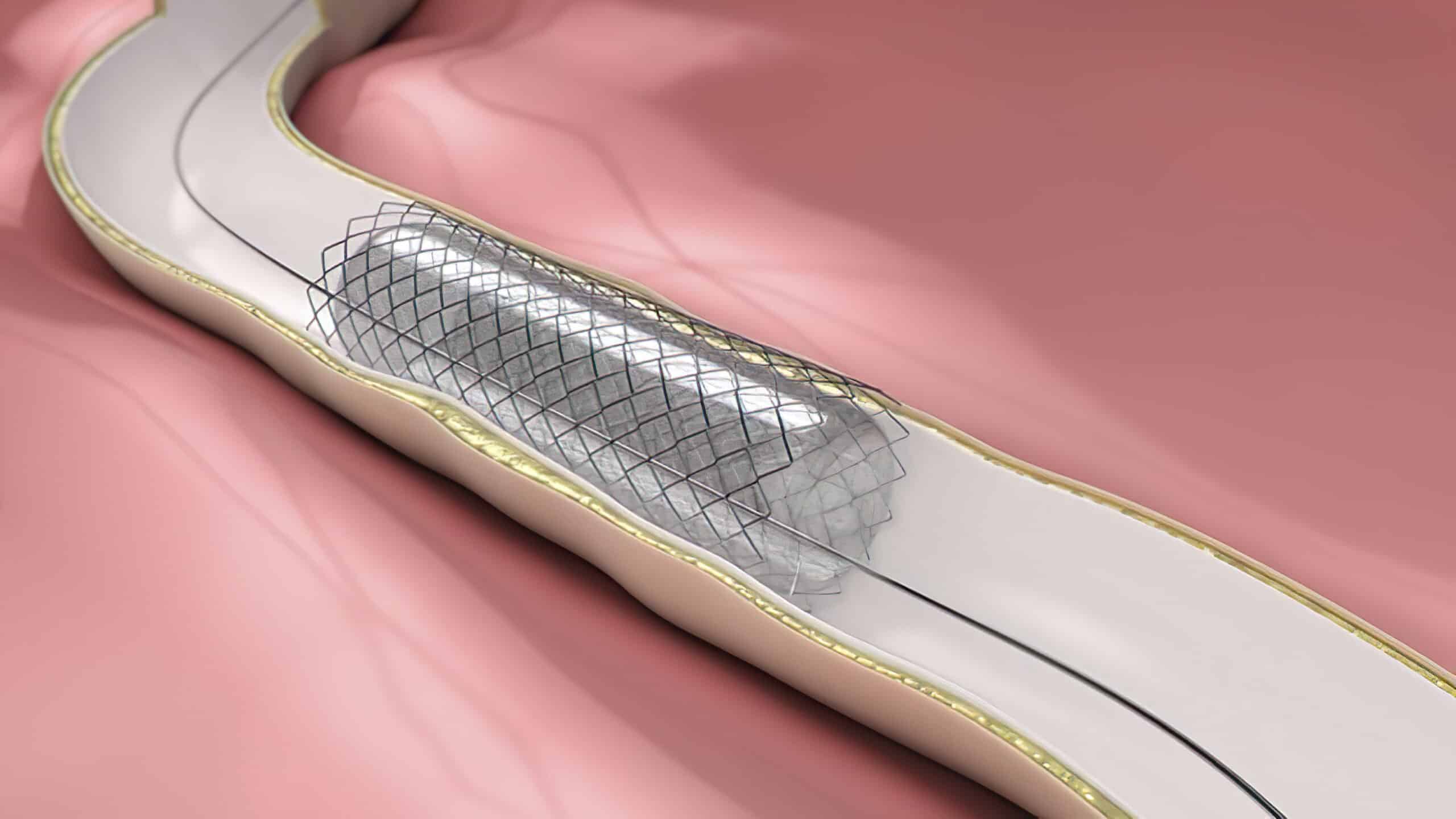 Stent placed in patient.